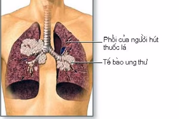 Do khói thuốc là chứa hơn 4000 chất hóa học gây ung thư. Hai chất gây ung thư chính trong khói thuốc là nitrosamine và hydrocacbon thơm đa vòng. Nếu bạn cai được thuốc thì nguy cơ này cũng bị hạ xuống do các tế bào trong phổi phát triển lại bình thường và thay thế các tế bào hư hại trong nó.