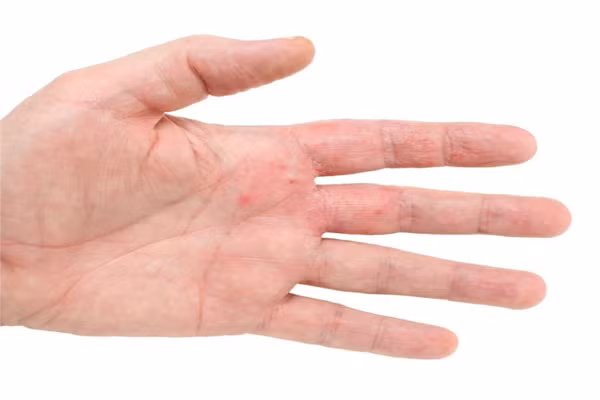Trường hợp bong tróc vảy cũng liên quan đến bệnh Eczema. Là trạng thái viêm lớp nông của da, cấp hay mạn tính, nổi đám mảng đỏ trên da, mụn nước, ngứa. Nguyên nhân của bệnh do cả yếu tố bên trong lẫn bên ngoài và liên quan đến dị ứng.
