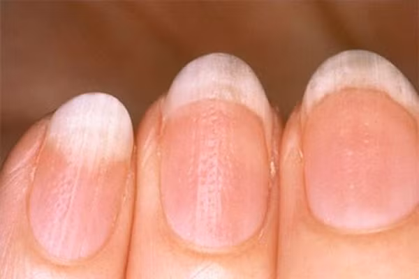 Đầu ngón tay nhợt nhạt, trắng hoặc xanh thì có thể là bạn mắc bệnh Raynaud – rối loạn mạch máu, viêm tĩnh mạch hoặc tắc nghẽn mạch máu. Nếu không được chăm sóc đúng cách, có thể sẽ gây tổn thương mô. Trong trường hợp này, bạn nên đeo găng tay khi ra ngoài trong thời tiết lạnh, hoặc gặp bác sỹ để được kê đơn thuốc.