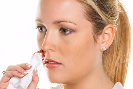 Hãy áp dụng những mẹo sau khi bị chảy máu cam. Khi thấy máu chảy, bóp chặt phần mềm dưới xương mũi. Cách này giúp tạo áp lực lên các mạch máu trong lỗ mũi, giúp máu đông dễ dàng hơn.