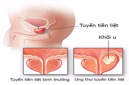 Phat hien ung thu khi kham tren bao duoi khong nghe
