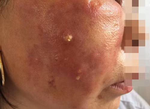 Nhiễm trùng mặt nặng nề vì ham làm trắng da siêu tốc - Hình 2 Nhiem trung mat nang ne vi ham lam trang da sieu toc-Hinh-2