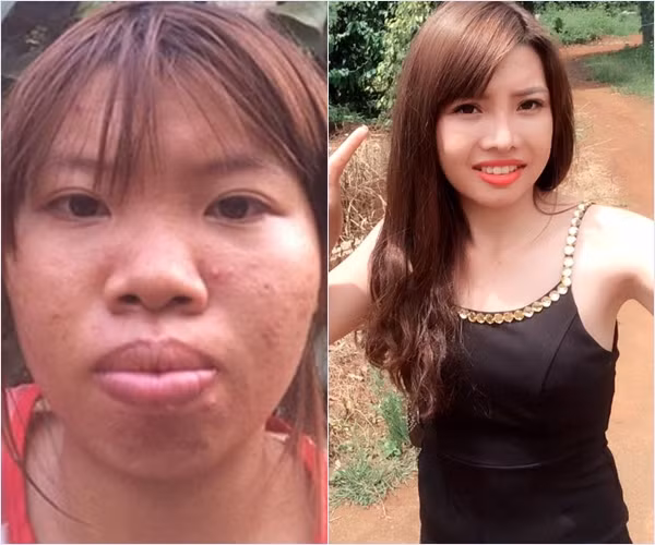 Những ngày qua, câu chuyện về bà mẹ đơn thân Quách Thị Kim Phượng phẫu thuật toàn bộ khuôn mặt để trở nên xinh đẹp vẫn nhận được nhiều sự quan tâm. Với màn lột xác ngoạn mục, bà mẹ 9X được mọi người gọi với biệt danh " Thị nở tái sinh" đã phải chi 150 triệu đồng để phẫu thuật thẩm mỹ.