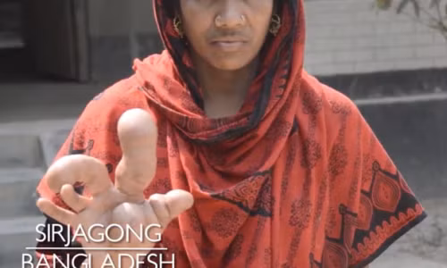 Cô Afroza Begum và ngón tay lạ. Cô Afroza Begum và ngón tay lạ.