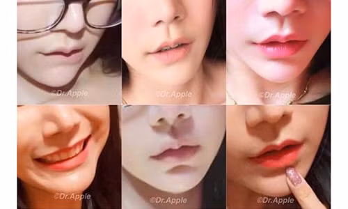 Kinh ngạc trào lưu “môi sừng trâu” của giới trẻ Thái Lan Kinh ngac trao luu “moi sung trau” cua gioi tre Thai Lan