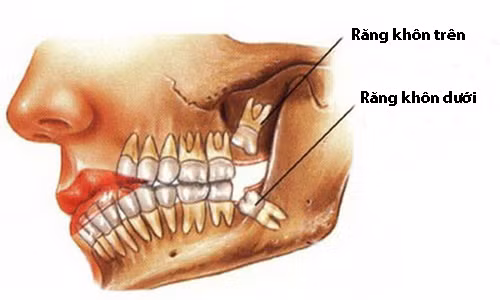 “Rang khon moc dai” va nhung bien chung chet nguoi
