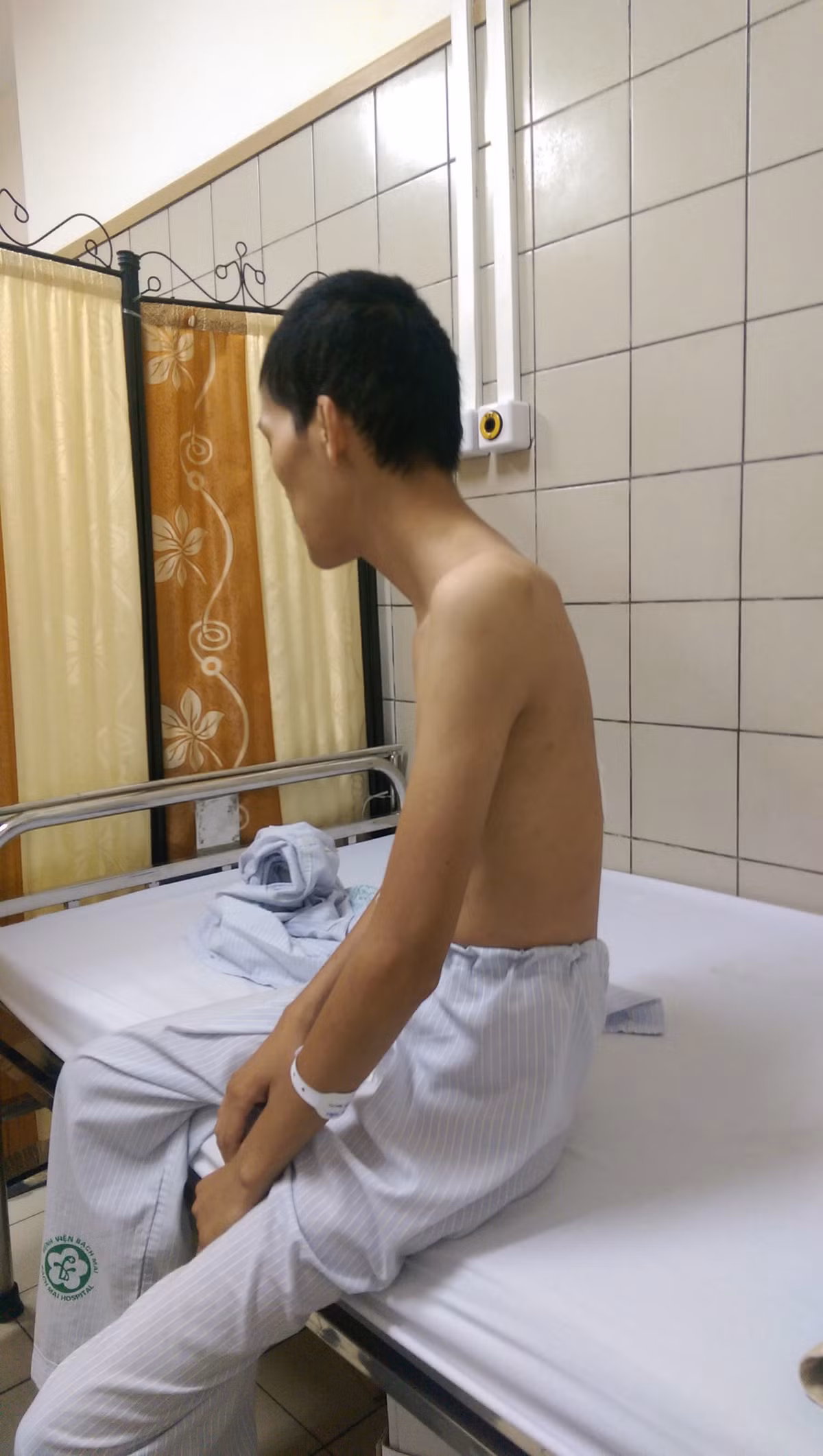 Phẫu thuật chỉnh hình cho bệnh nhân gù nặng - Hình 2 Phau thuat chinh hinh cho benh nhan gu nang-Hinh-2