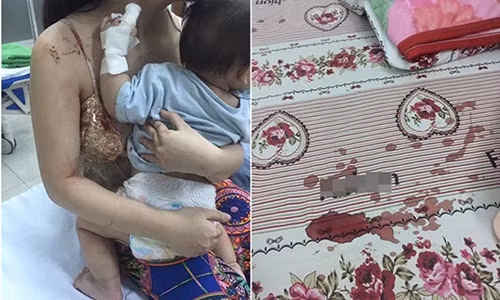 Mẹ sốc vì con bị chuột cắn nát tay khi đang ngủ Me soc vi con bi chuot can nat tay khi dang ngu
