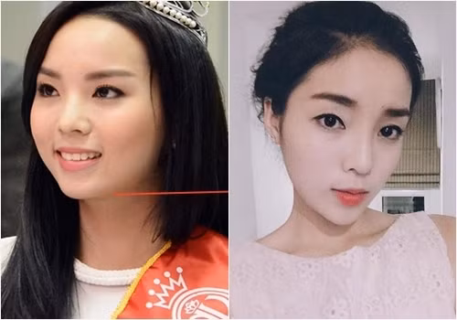 Hoa hậu Kỳ Duyên khiến dư luận dậy sóng trước tin đồn thẩm mĩ. Đó là bởi chiếc cằm nhọn, sống mũi cao nhọn bất thường nhưng không thể phủ nhận được Hoa hậu Việt Nam 2014 đẹp lên thấy rõ.