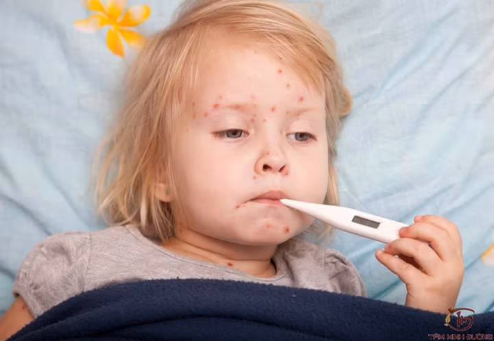 Bệnh sởi: Sởi là một bệnh truyền nhiễm do virus gây ra và dễ bùng phát thành dịch, bệnh thường gặp ở trẻ em. Bệnh thường xuất hiện vào mùa hè và lây truyền theo đường hô hấp.