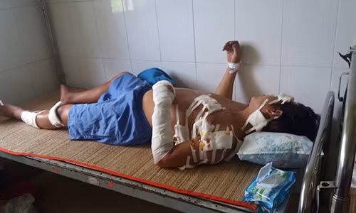 Nghi ngoai tinh, vo mua dao chem chong gan 20 nhat