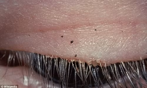 Hình ảnh tổ rận mu sống trên mi mắt người.