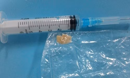 Miếng mít được gắp ra từ phế quản của trẻ. Miếng mít được gắp ra từ phế quản của trẻ.