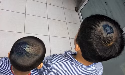 Nấm tổ ong vùng đầu do lây từ chó mèo Nam to ong vung dau do lay tu cho meo