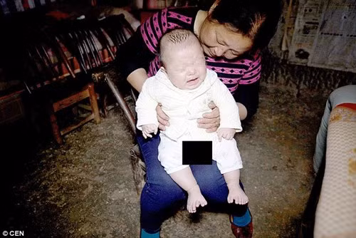 Tuy nhiên, khi em bé chào đời, cha mẹ em đã bị sốc khi chứng kiến con mình mắc dị tật còn nghiêm trọng hơn cả mẹ. Mỗi bàn chân của em bé có 8 ngón; một tay có 8 ngón và tay còn lại có 7 ngón. Theo Dailymail, cứ 1.000 ca sinh thì có 1 ca mắc dị tật thừa ngón. Tuy nhiên, trường hợp thừa nhiều ngón như của bé Hồng Hồng là cực kì hiếm.