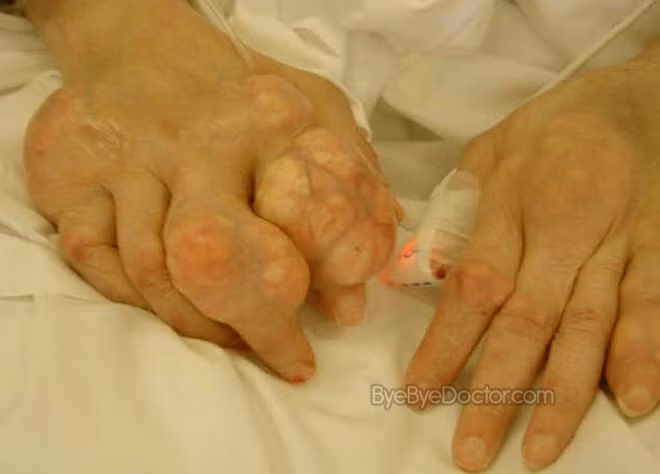 Nếu nói rằng, bệnh Gout gây đau đớn và vô cùng khó chịu cho người bệnh thì khi chứng kiến những biến chứng của bệnh gút nếu không được điều trị kịp thời nhiều người không khỏi kinh hoàng.