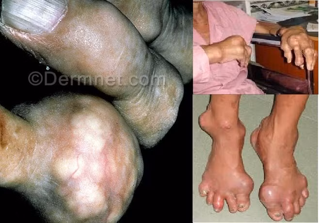 Nhìn những bàn tay, bàn chân đang lành lặn bỗng dưng bị biến dạng, các khớp sưng vù, lở loét, toàn thân đầy u nhọt kinh khủng ..... ít ai nghĩ đến đó là biến chứng nguy hiểm từ thói quen ăn uống, sinh hoạt thiếu lành mạnh và là biến chứng của căn bệnh mang tên bệnh gout (còn gọi là thống phong).