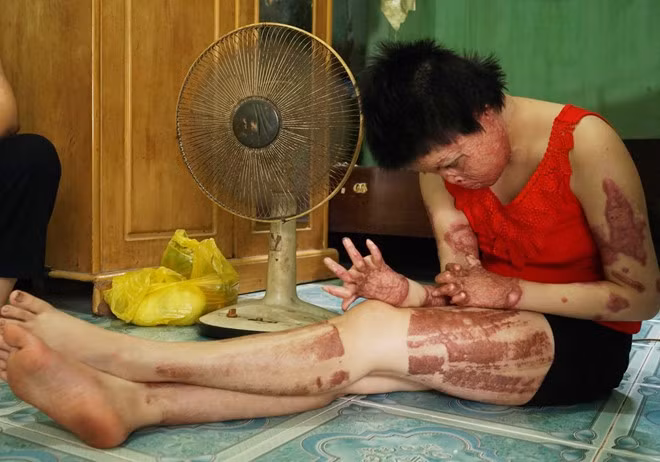 Người vợ trẻ mong được phẫu thuật để có thể đi làm kiếm tiền nuôi hai con gái. Ảnh: Quỳnh Như.