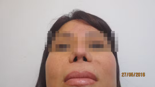 10 năm thở bằng miệng do 6 lần nâng mũi 10 nam tho bang mieng do 6 lan nang mui