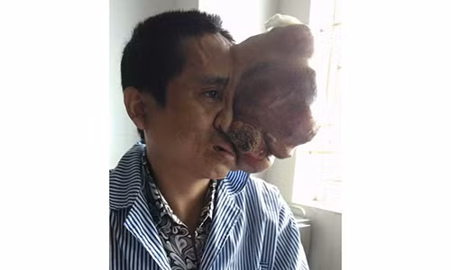 Nguoi dan ong bien dang khuon mat vi khoi u khong lo