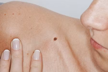 Đường kính: Một điểm đáng ngờ khi quan sát các nốt lạ trên da là đường kính của chúng lớn hơn hẳn các nốt ruồi thông thường. Nốt ruồi thường chỉ nhỏ hơn hoặc bằng khoảng 6mm.