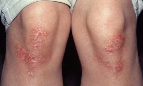 Bệnh vảy nến. Bệnh vẩy nên là một loại viêm da tự miễn dịch xảy ra do cơ thể thiếu hụt vitamin D. Trung tâm PubMed của Anh đã công bố một nghiên cứu trong đó, những người mắc bệnh vảy nến được bổ sung vitamin D tổng hợp thì tình trạng bệnh sẽ được cải thiện đáng kể.
