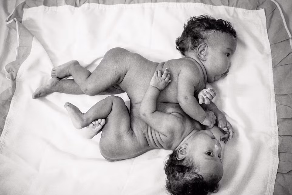 Maria Clara và Maria Eduarda Oliveira Santana bị dính liền phần bụng và có chung một lá gan.