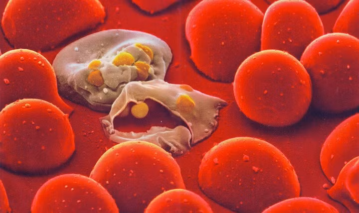 2. Bệnh tan máu huyết tán Thalassemia: Là một trong những căn bệnh di truyền ở người, liên quan đến máu và có thể gây ra các biến chứng nguy hiểm cho người bệnh. Nguyên nhân gây ra căn bệnh này là do các gen lặn ở bố và mẹ, nếu cả bố mẹ đều mang gen bệnh thì 75% trẻ sinh ra bị mắc bệnh này. Bệnh kéo dài đến suốt cuộc đời bệnh nhân và họ sẽ phải truyền máu cả đời. Một số triệu chứng của bệnh như là thiếu máu thường xuyên và thừa sắt. Nếu ở thể bệnh nặng, trẻ thường tử vong sau khi sinh khoảng 4 tháng.