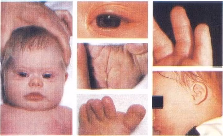 3. Hội chứng Down (tên tiếng Anh là Down Syndrome) là một rối loạn về di truyền xảy ra khi sự phân chia tế bào bất thường dẫn đến việc có thêm một hoặc một phần bản sao của nhiễm sắc thể số 21. Vật chất di truyền tăng thêm này gây ra những thay đổi trong sự phát triển và biểu hiện về thể chất của hội chứng Down.