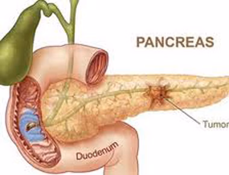 5. Có nhiều cách để phát hiện ung thư tụy như chụp CT, MRI. Ở đó, chụp CT và MRI có thể phát hiện ra các khối u lớn hơn 2 cm trong tuyến tụy. Song với các khối u nhỏ hơn thường khó phát hiện. Nhìn chung, tiến hành siêu âm nội soi (EUS) được xem là phương pháp hữu hiệu để phát hiện. Phương pháp này có thể phát hiện các khối u nhỏ mà chụp CT hoặc MRI không thể nhìn thấy.