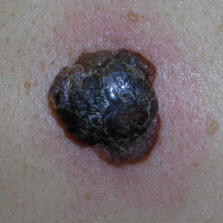  Bạn có thể nhận dạng khối u nodular melanomas do chúng thường có màu đỏ, hồng, nâu hoặc đen nhạt. Đặc biệt, chúng thường có viền ngoài, hình vòm. Sau thời gian phát triển, u da nodular melanoma nhanh chóng tróc vảy và chảy máu gây khó chịu. 