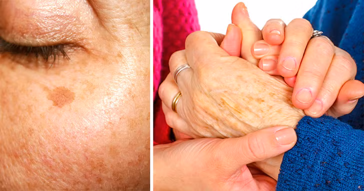 Các vết nám, đốm đen trên da mặt. Ảnh BS