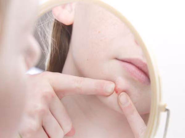 Điều trị mụn nhọt: Nếu gặp phải các vấn đề về mụn, bạn có thể sử dụng gel lô hội để bôi lên nốt mụn. Phương pháp này không chỉ giúp mụn bớt sưng tấy mà còn chống lây lan nhiều hơn. 