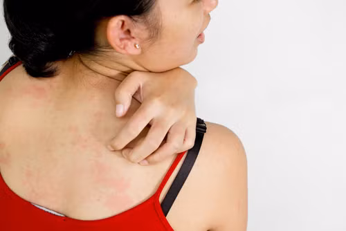 Người dị ứng thực phẩm. Chế độ thuần chay chủ yếu nhờ rau và các loại đậu và trong nhiều trường hợp dị ứng với đậu nành cũng có thể phản ứng với các loại đậu và các loại hạt khác. Ảnh: Thuoctot.