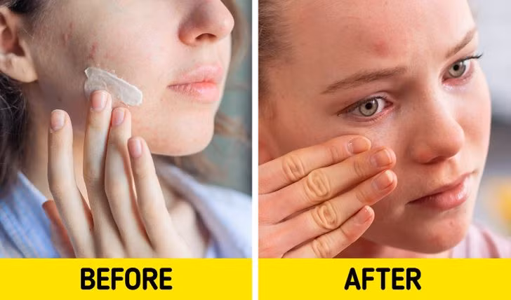Sản phẩm trị mụn: Một số sản phẩm trị mụn có thể khiến da khô và kích ứng. Mặc dù đây chỉ là triệu chứng tạm thời nhưng da vẫn có thể bị ngứa, bong tróc hay thậm chí là bỏng.