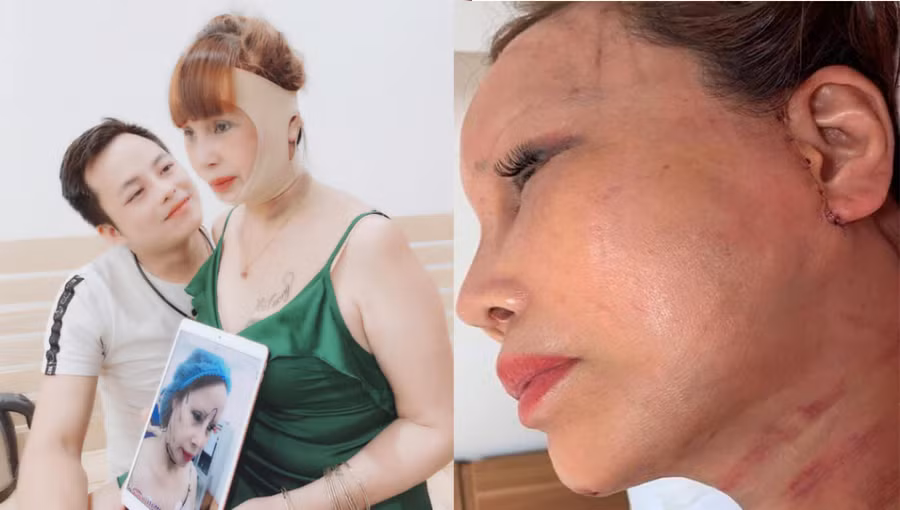 Dù đối mặt với nhiều biến chứng và những ý kiến trái chiều từ phía dư luận nhưng cô dâu Thu Sao vẫn khá lạc quan và vẫn muốn tiếp tục làm đẹp thêm. Thậm chí mới đây, cô dâu Thu Sao tiết lộ mình phải đi điều trị chữa méo miệng tại bệnh viện.