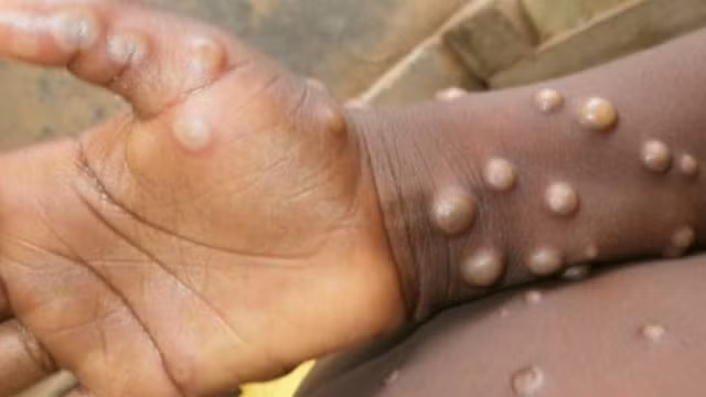 6 cau hoi lon ve benh dau mua khi ai cung thac mac-Hinh-2