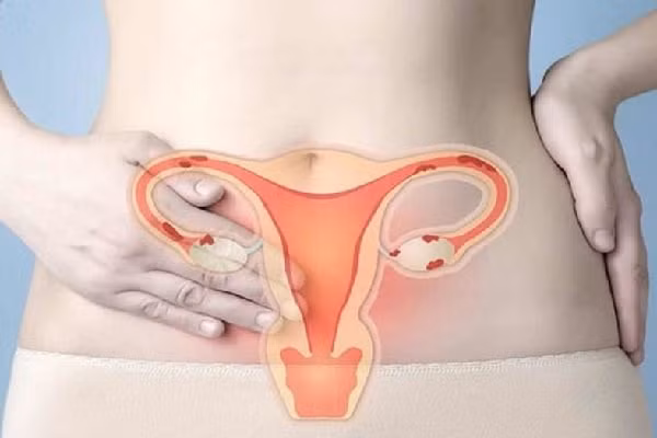 Dấu hiệu trên quần lót này có thể là màu máu đỏ tươi, dịch tiết màu đỏ ngầu hoặc dịch tiết màu nâu. Số lượng dịch tiết có thể nhiều hoặc ít song không vì thế mà chủ quan. Chuyên gia sức khỏe cho rằng nó có thể là dấu hiệu ung thư cổ tử cung. Biểu hiện lâm sàng này còn được biết đến với tên gọi “ra máu bất thường”.