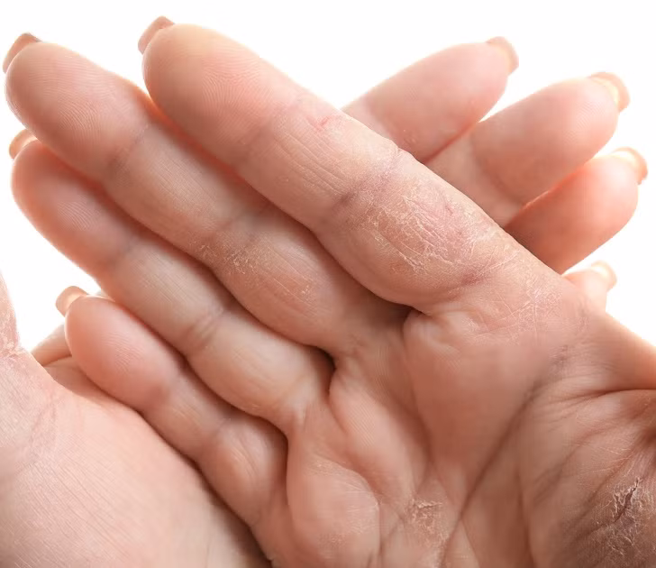 Tay khô và da khô trên cơ thể: Khi da khô, bạn có thể sử dụng kem dưỡng ẩm,uống nhiều nước và bổ sung vitamin. Nhưng nếu đã thực hiện các biện pháp trên mà không khỏi, thì da, tay khô có thể là dấu hiệu của bệnh tiểu đường và suy tuyến giáp hoặc do dị ứng với hóa chất tiếp xúc.