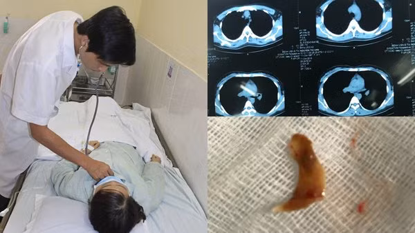 Cô gái ăn thịt vịt, xương đi lạc trong người 3 tháng Co gai an thit vit, xuong di lac trong nguoi 3 thang