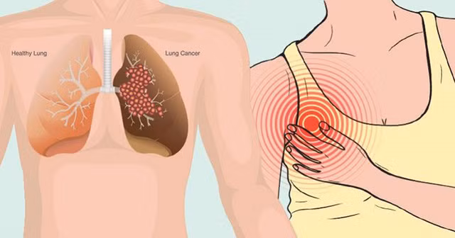 Thường xuyên bị nhiễm trùng: Ung thư phổi có thể gây ra tình trạng nhiễm trùng ảnh hưởng đến đường hô hấp và dẫn đến các bệnh như viêm phế quản hoặc các bệnh nhiễm trùng mãn tính khác. Nếu bạn bị nhiễm trùng phổi mãn tính, bạn nên đi chụp X-Quang phổi để biết mình có nguy cơ bị ung thư phổi hay không.