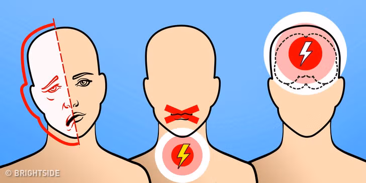Khó nói hoặc nói nhịu: Người bị đột quỵ sẽ cảm thấy khó khăn trong giao tiếp, phát âm hoặc không nói được, khả năng nhận biết lời nói của người khác cũng chậm hơn.