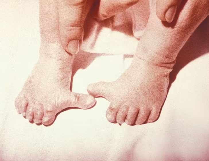Tình trạng polydactyly (dị tật thừa ngón) khiến một số người có nhiều ngón chân hơn bình thường.