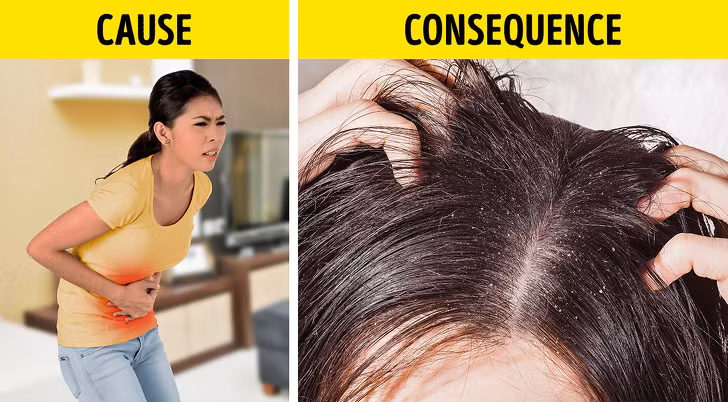 Tóc nhiều các mảng vẩy: Nhiều người cho rằng những mảng vảy trên da đầu là gàu, tuy nhiên nó có thể là dấu hiệu cảnh báo bệnh vẩy nến hoặc các bệnh tự miễn dịch khác. Ngoài ra, tóc gàu cũng có thể là do căng thẳng, các vấn đề đường tiêu hóa hoặc suy giảm miễn dịch.