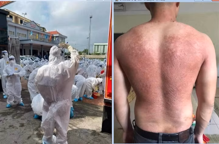  Hình ảnh y bác sĩ ở tâm dịch Bắc Giang lưng phồng rộp vì mặc đồ bảo hộ trong thời tiết nóng khiến dân mạng xót va và biết ơn, kêu gọi hỗ trợ chống dịch. 