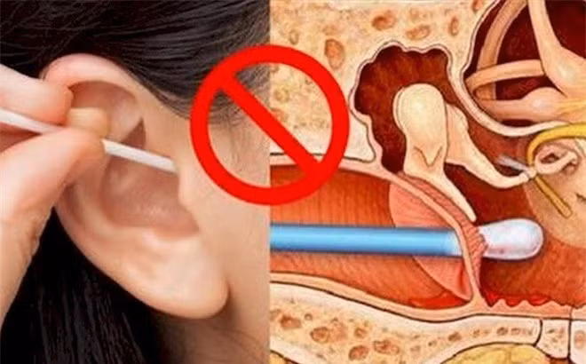 Người phụ nữ suýt bị điếc vì thói quen nhiều người Việt mắc phải - Hình 2 Nguoi phu nu suyt bi diec vi thoi quen nhieu nguoi Viet mac phai-Hinh-2