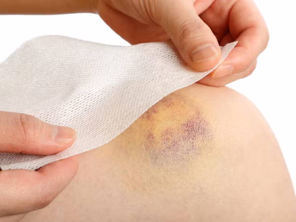 Dễ bầm tím: Dấu hiệu ban đầu của bệnh bạch cầu là bị suy yếu khả năng vận chuyển oxy trong máu và hình thành cục máu đông. Vì vậy, nếu bạn dễ bị bầm tím trên người dù không bị chấn thương hay va chạm mạnh thì đó cũng có thể là dấu hiệu của bệnh ung thư máu.