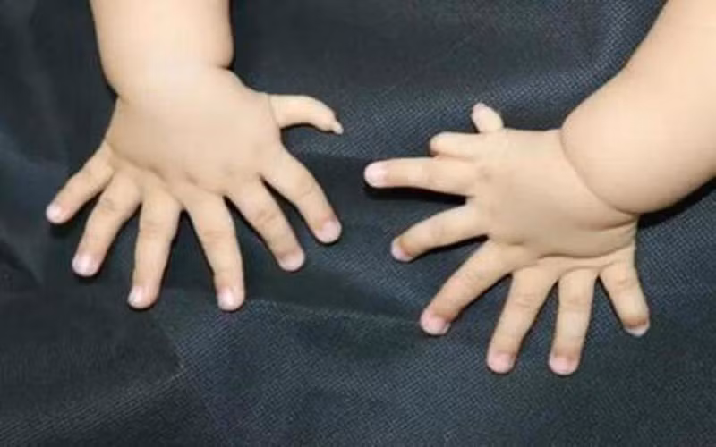 Chứng đa ngón: Người bị chứng đa ngón có nhiều hơn 10 ngón tay hoặc ngón chân, trong đó ngón thừa thường không có xương, chỉ có phần mềm (da, cơ, tổ chức liên kết).