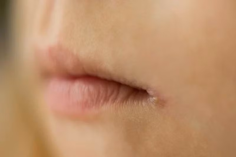 Viêm môi vùng mép: Viêm môi vùng mép thường bắt đầu từ vết nứt nẻ ở mép nhưng rồi có thể lan ra khắp môi nếu không được chữa trị. Có nhiều nguyên nhân gây viêm môi, như thiếu vitamin hoặc do liếm môi quá nhiều.