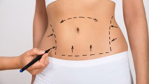 Việc hút mỡ bụng khá nguy hiểm và có thể gây biến chứng, ảnh hưởng đến tính mạng nếu xảy ra các sai sót hay lỗi kỹ thuật. Những trường hợp hoại tử do hút mỡ và tạo hình thành bụng chủ yếu xuất phát từ việc làm sai kỹ thuật (hút mỡ sai vị trí, hút quá nông hoặc quá sâu) gây tổn thương đến các mạch nuôi vùng da bụng.